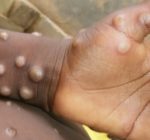State public health officials monitoring suspected Monkeypox Cases