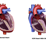 The silent threat of HCM
